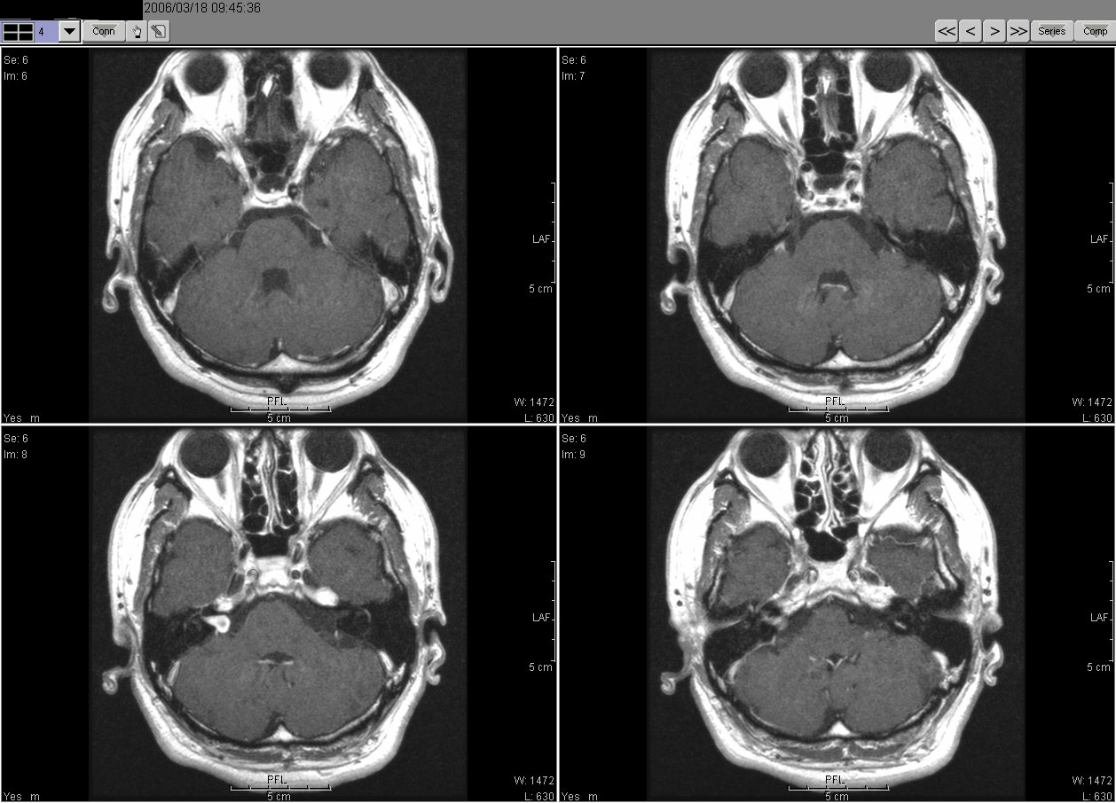 2006_03_18MRI02